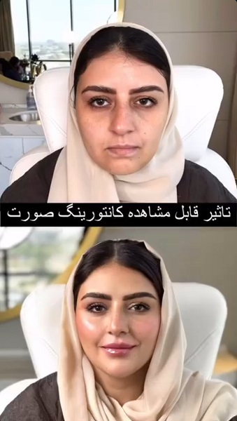 نمونه زاویه سازی صورت دکتر آریا شفیعی