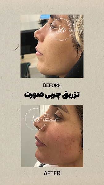 نمونه تزریق چربی - دکتر سوسن احمدی