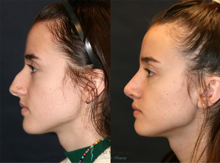 رینوپلاستی