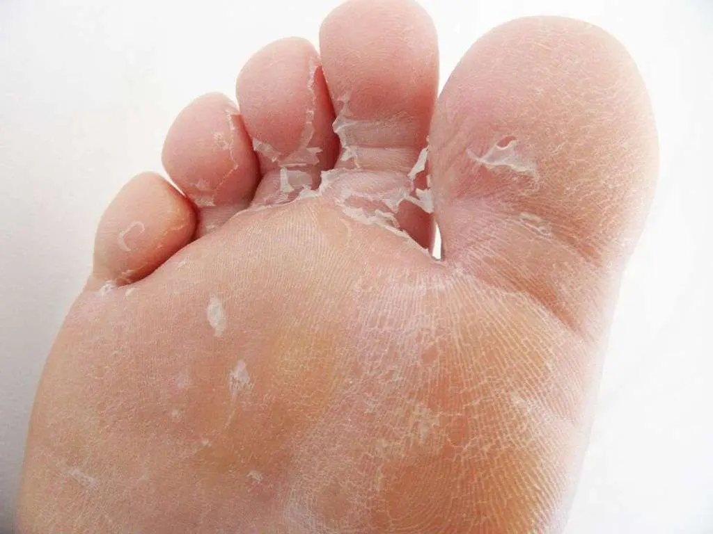 peeling-feet-causes