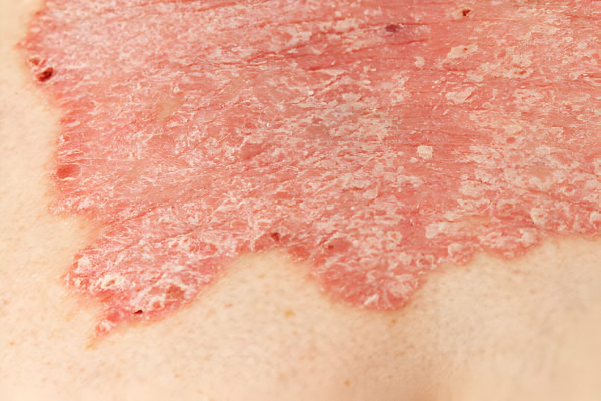 استفاده از سلول های بنیادی در ترمیم زخم