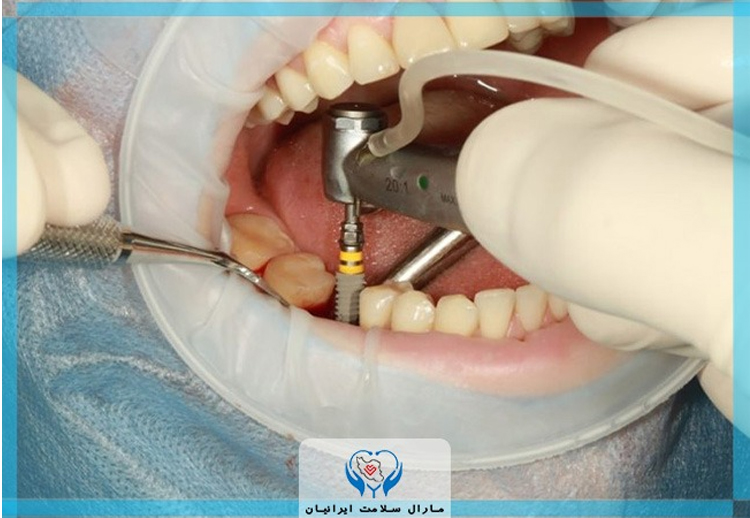 مارال ایمپلنت