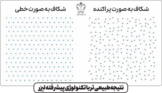 نتیجه کاشت مو با لیزر