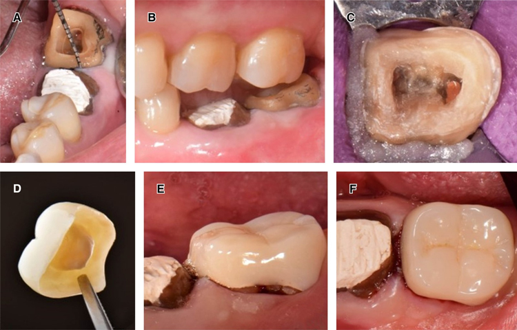 کاربردهای اندوکران