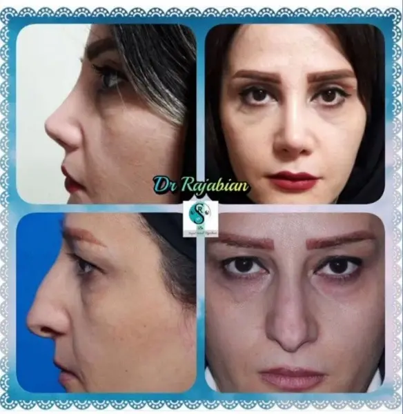 جراحی پلک نمونه های دکتر سعید رجبیان