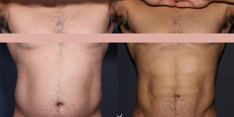 عمل پیکر تراشی (لیپومایتک) برای چه کسانی مناسب است؟