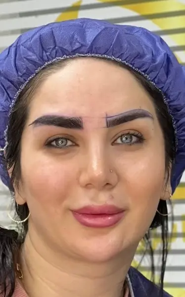 نمونه کاشت ابرو در کلینیک آرتان