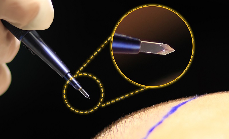 نحوه کاشت مو