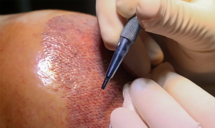 مهمترین ویژگی کاشت مو با لیزر چیست؟