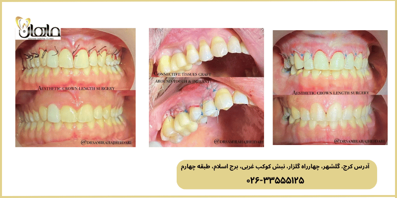 برای ایمپلنت و جراحی لثه در کرج به کجا مراجعه کنیم؟