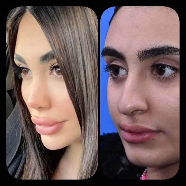 نمونه جراحی بینی دکتر سعید رجبیان