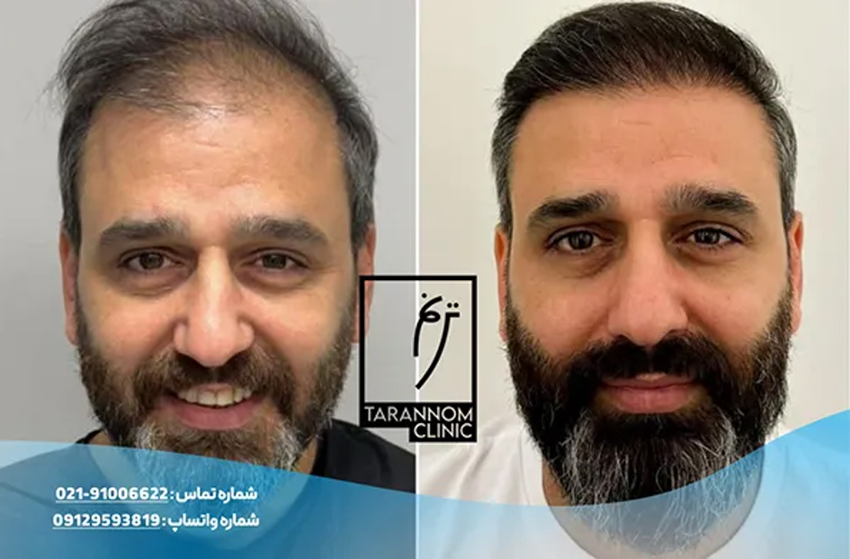 کاشت مو چیست؟