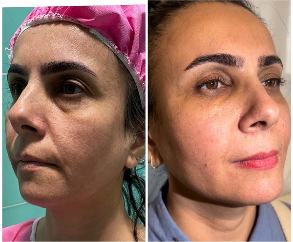 تصویر قبل و بعد از جوانسازی و لیفت پوست صورت به روش نوراریژن - دکتر افسانه ثنایی