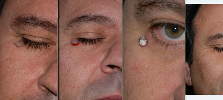 مراقبت های پس از فریز کردن خال گوشتی