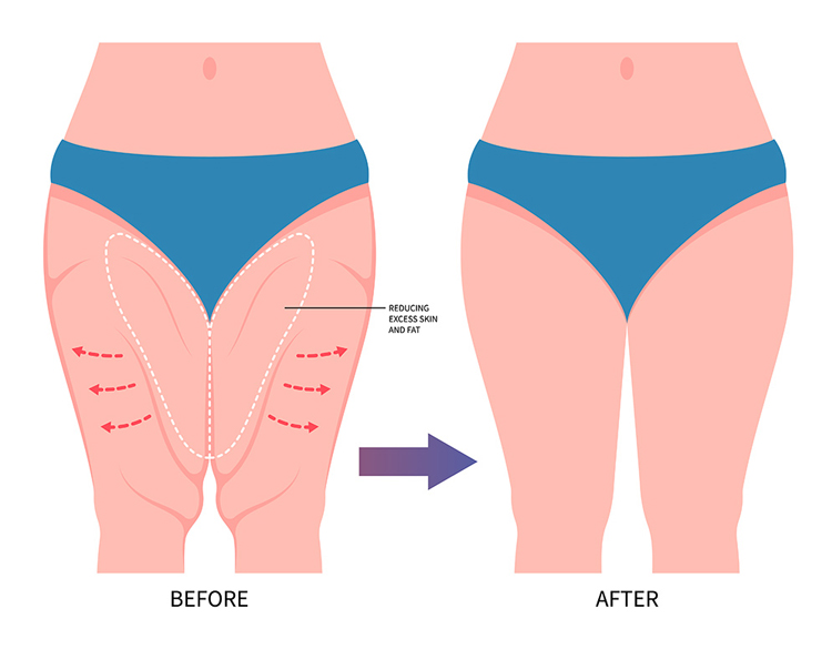 هزینه جراحی لیفت ران