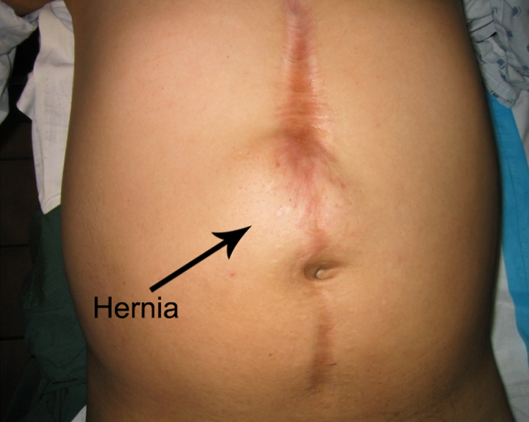 فتق برشی یا پس از جراحی