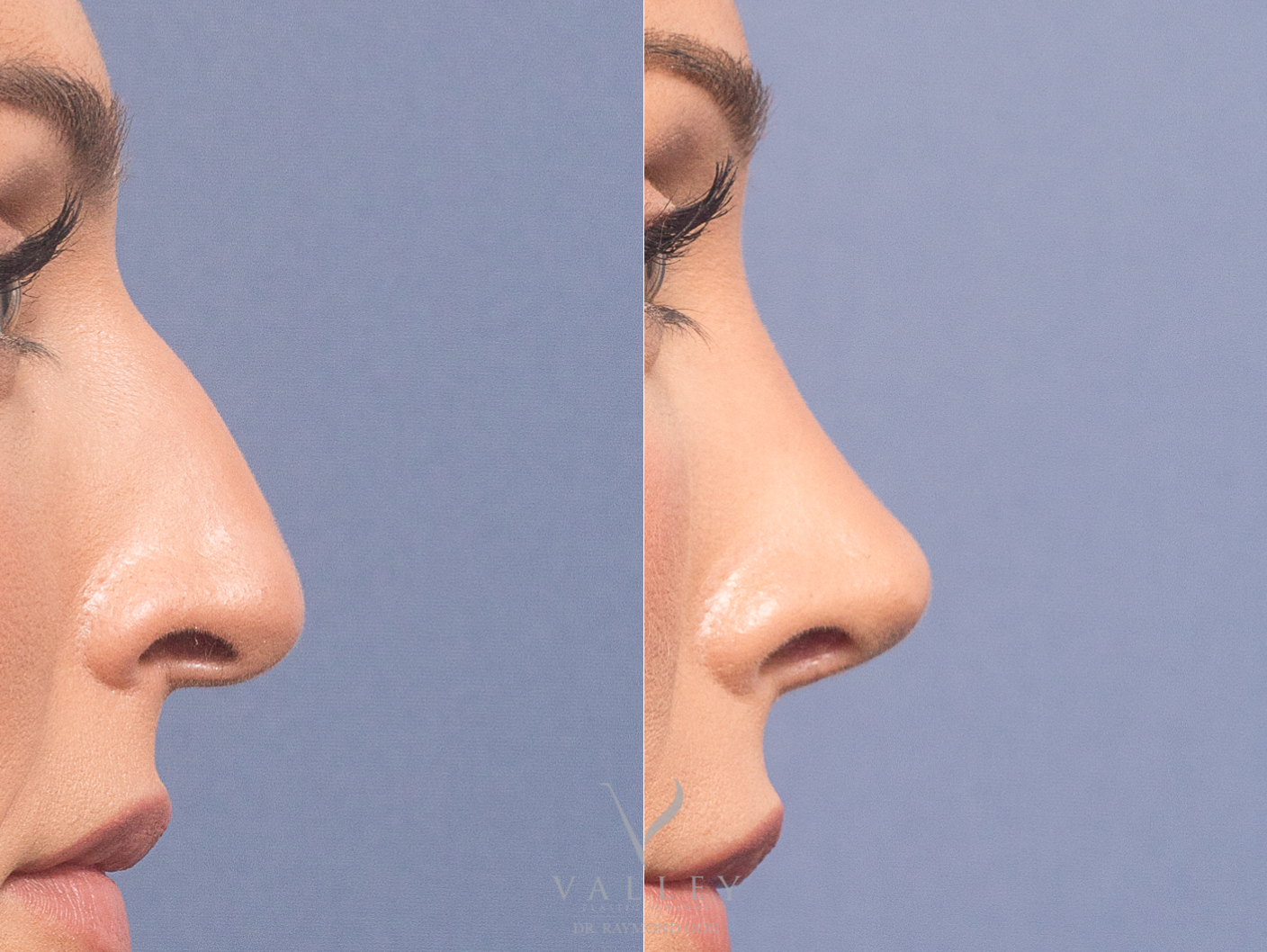 Nose-Surgery-7