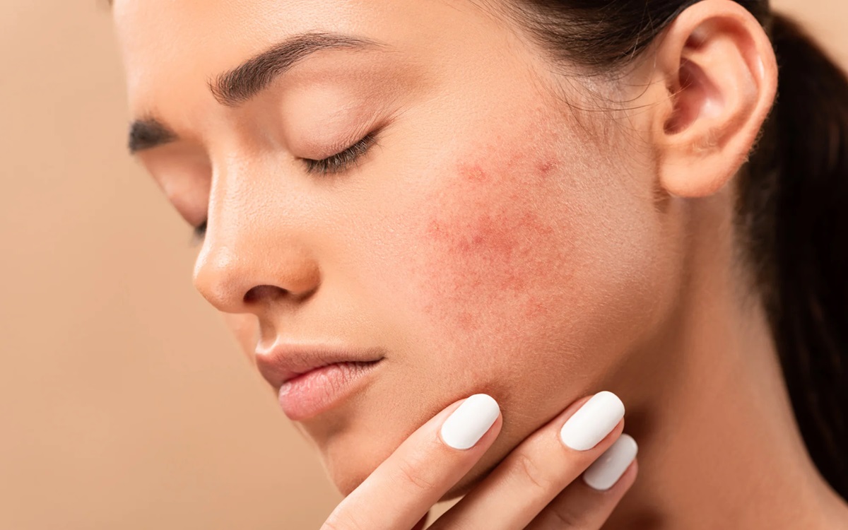 acne-scar-best-home-remedies