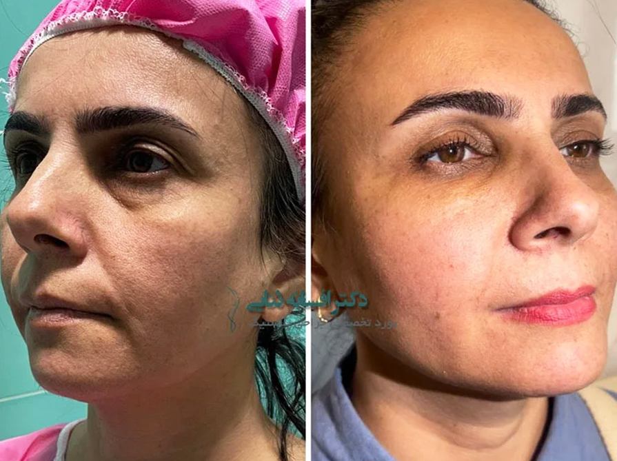 نمونه روش نوراریژن توسط دکتر ثنایی