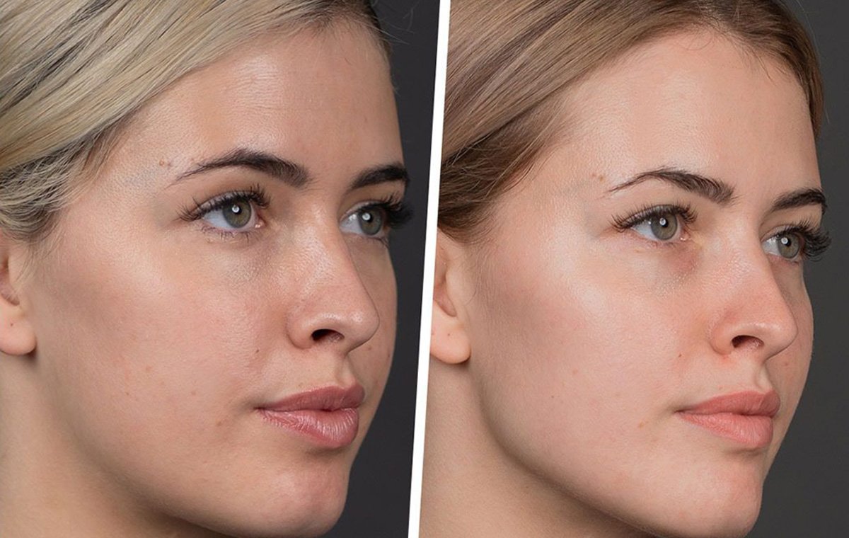 تزریق ژل گونه چگونه انجام می‌شود؟