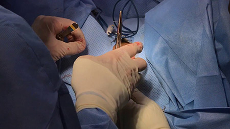 لابیاپلاستی در تهران