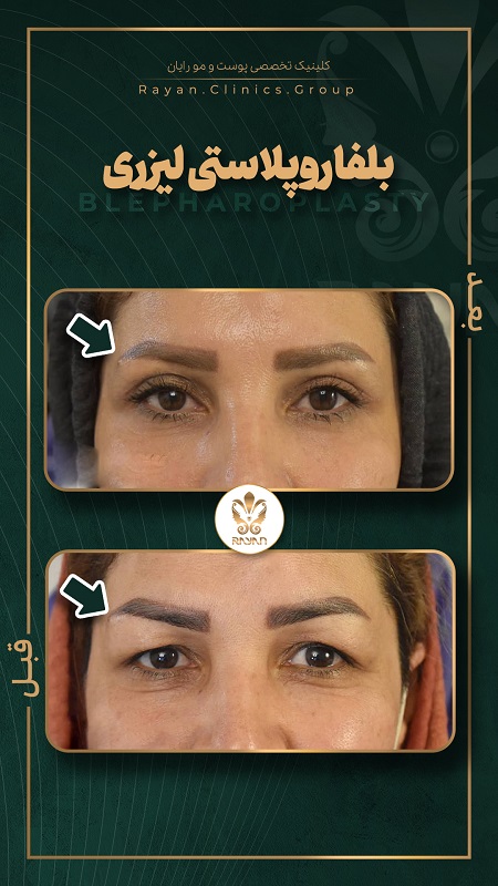 Story Before After Belfa 3