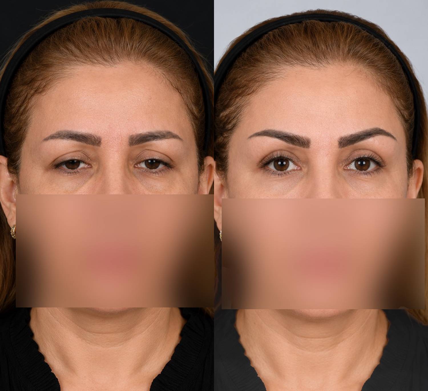 نمونه لیفت شقیقه-ل02