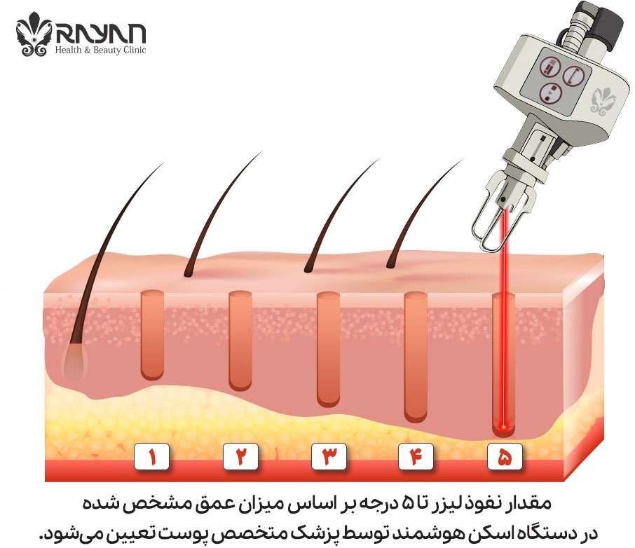 نحوه کاشت مو با لیزر