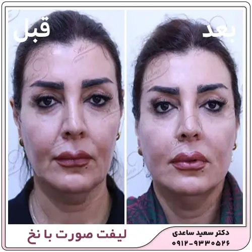 Thread-face-lift-example-3