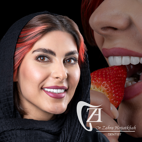 نمونه لمینت دندان در مرکز دندانپزشکی دیجیتال دکتر زهرا حجت خواه