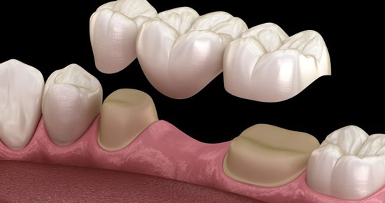 پروتز دندان چیست و چه انواعی دارد؟ 