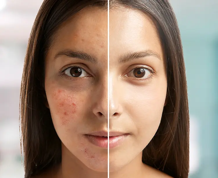 مزوتراپی پوست