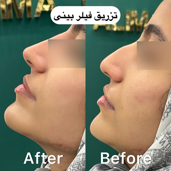 نمون فیلر بینی کلینیک آلیما