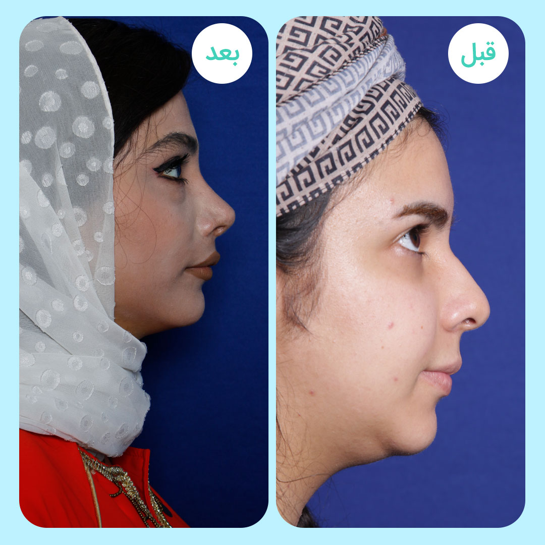 نمونه جراحی بینی دکتر لیلا نوری