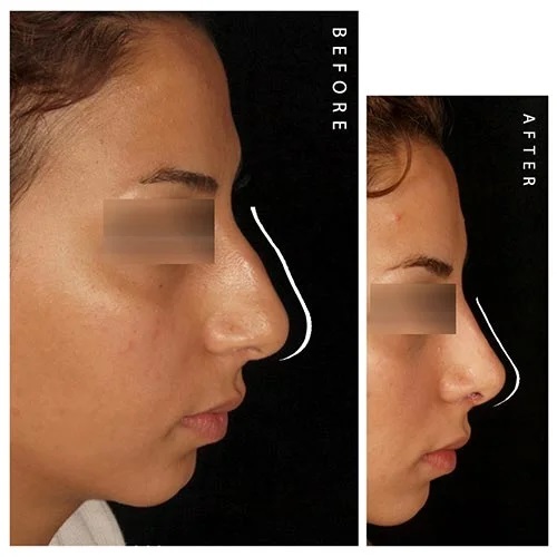 نمونه جراحی بینی استخوانی - دکتر علی اصغر شیرازی