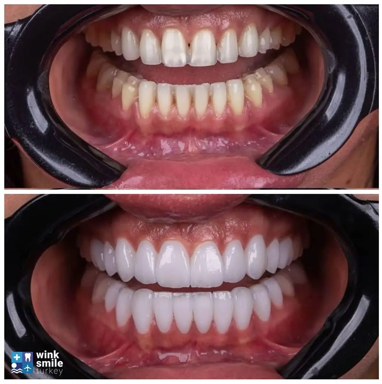 ماندگاری لمینت بالاتر است یا کامپوزیت؟