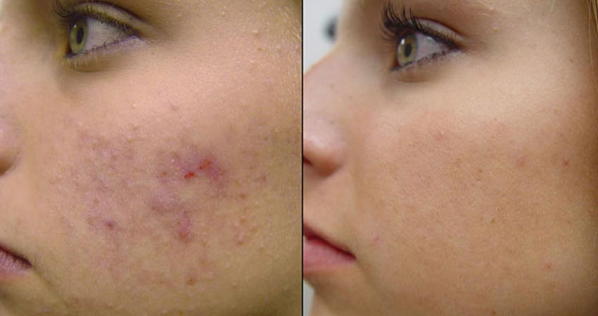 دستگاه های میکرونیدلینگ