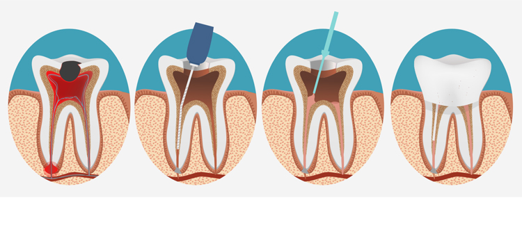 چرا پرداخت هزینه برای عصبکشی دندان مهم است؟