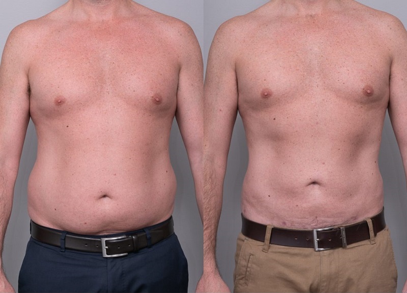 پیکرتراشی+با+ابدومینوپلاستی