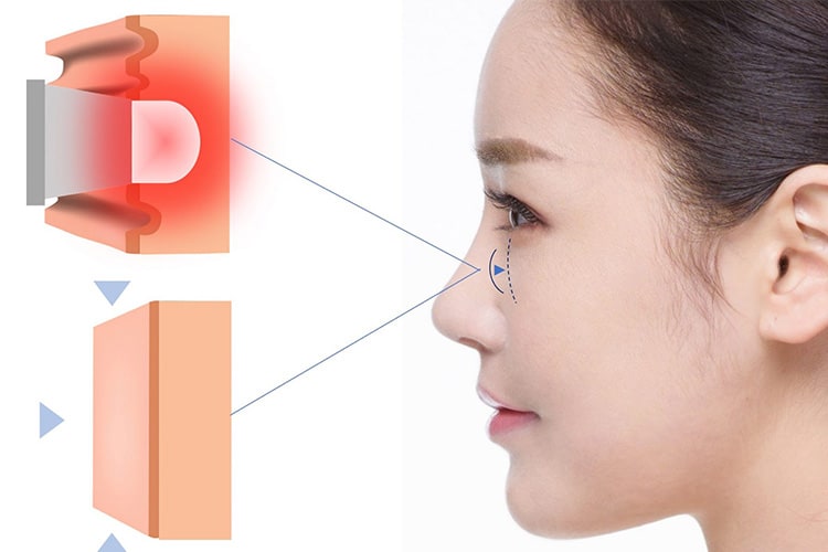 eye-bag-treatment-1