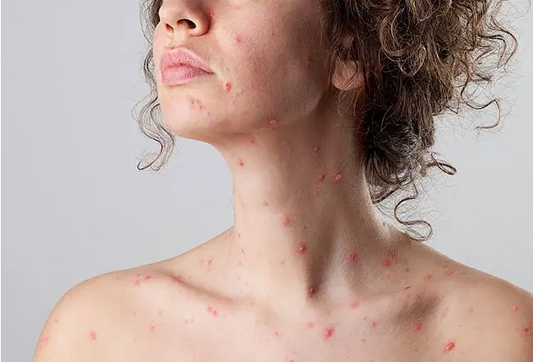 چطور می توان از ایجاد جای آبله مرغان بر روی پوست جلوگیری کرد؟