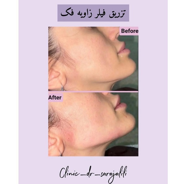 نمونه کانتورینگ صورت - دکتر سارا جلیلی