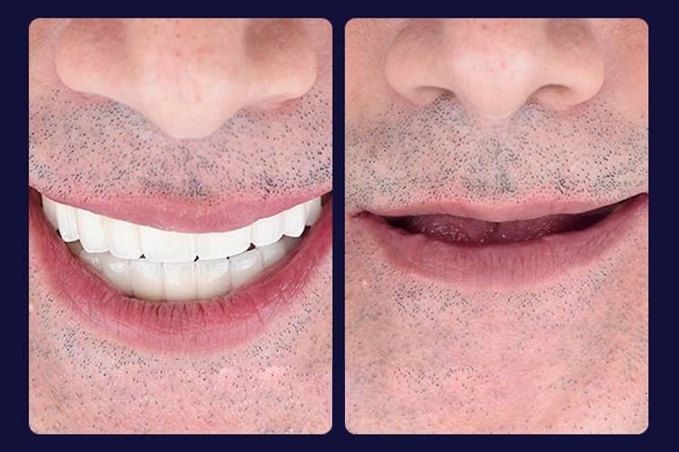 مارال ایمپلنت