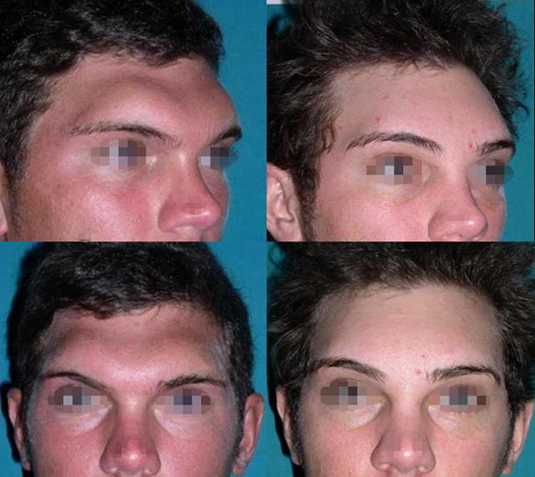 عمل جراحی پیشانی ناندرتال چیست؟