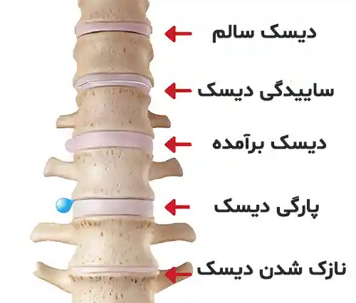 دیسک کمر چیست؟ علائم، علل و روش‌های درمان