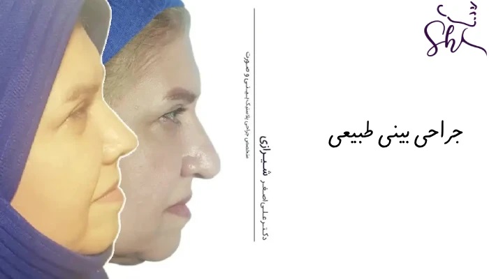 نمونه عمل بینی طبیعی - دکتر علی اصغر شیرازی