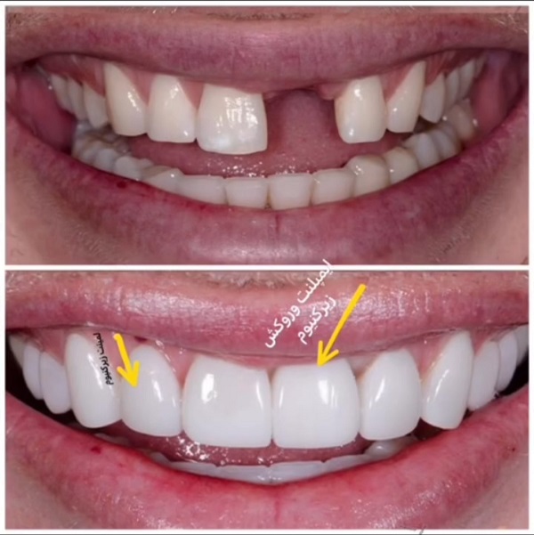 بررسی کامل مزایا و معایب ایمپلنت دندان + عوارض احتمالی