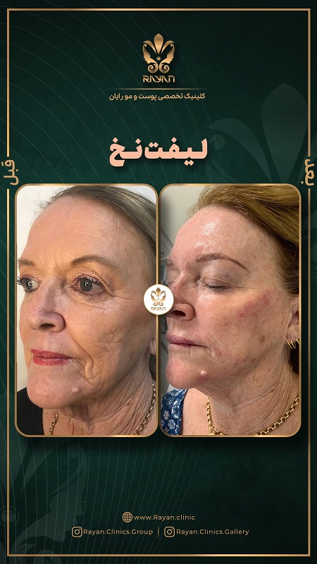 لیفت صورت با نخ - کلینیک رایان سلامت