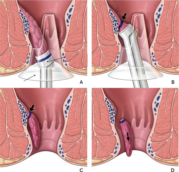درمان بیماری های نشیمنگاه چگونه است؟