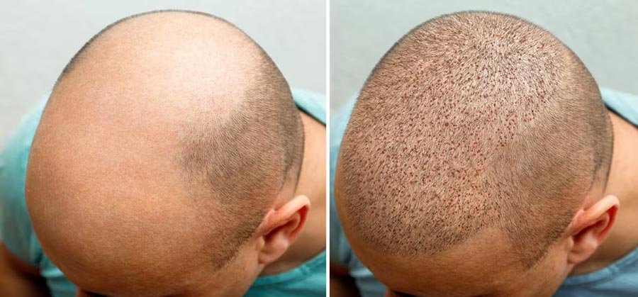 کاشت مو به روش FUE (Follicular Unit Extraction)